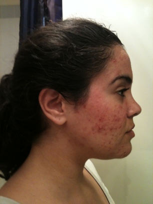 This shows the scarring, breakouts and hyperpigmentation
